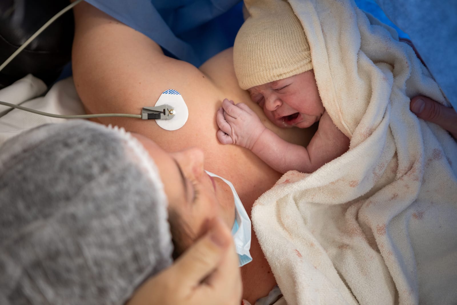 Anesthesia for Cesarean Section