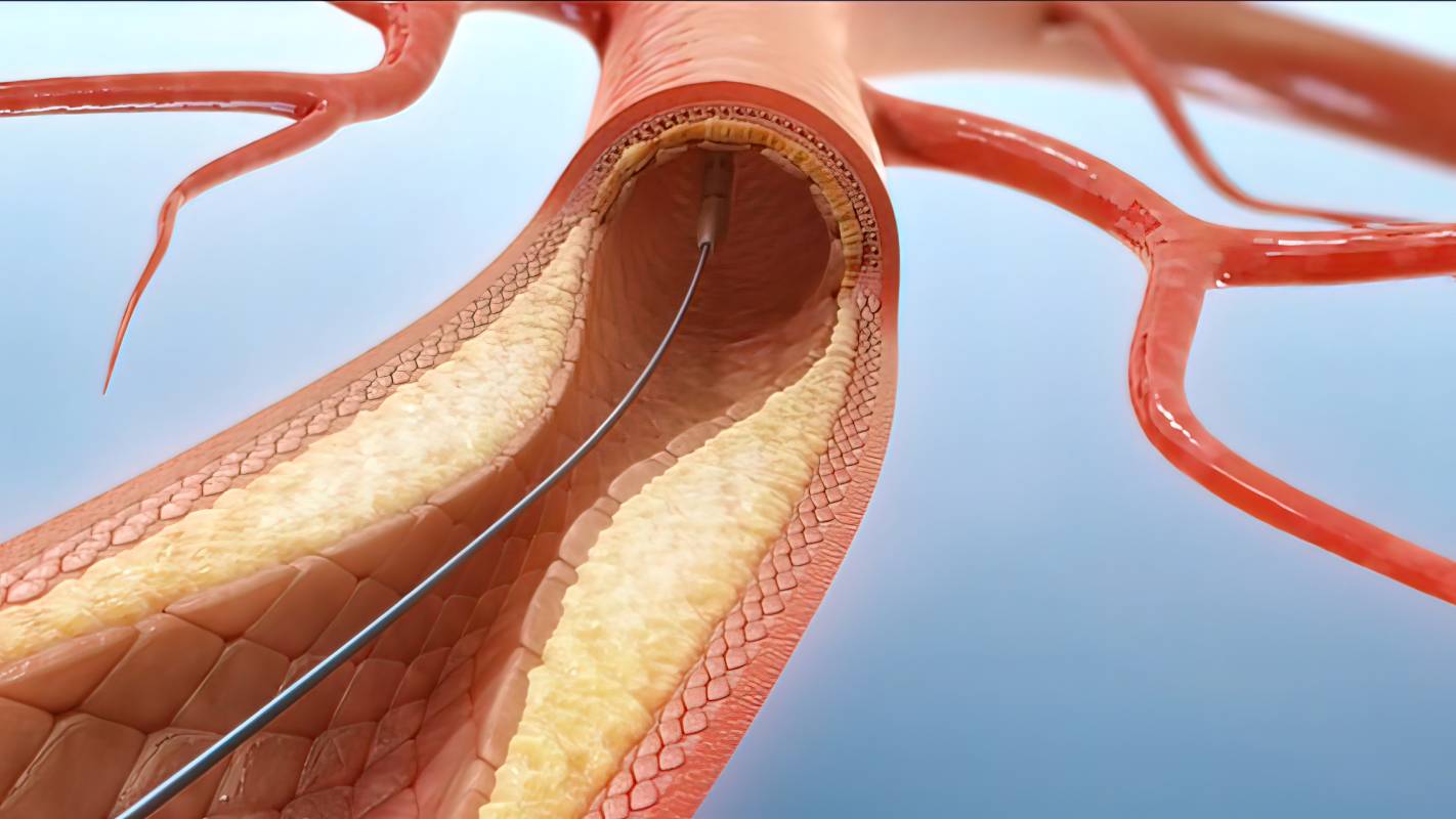 Cardiac Bypass vs. Stenting