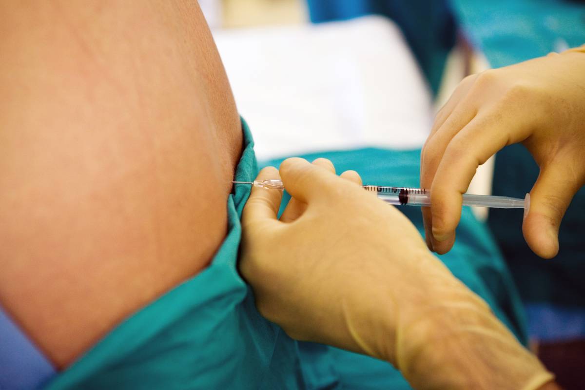 Needle Selection for Neuraxial Anesthesia